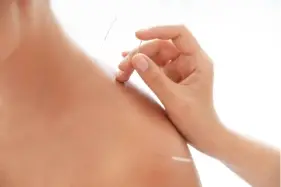 Acupuncture