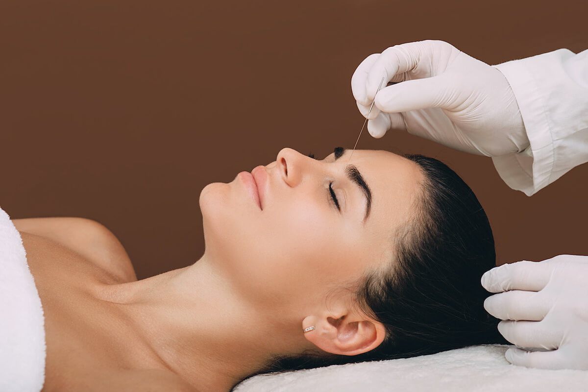 acupuncture for migraines