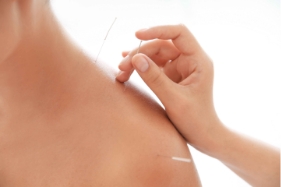 Acupuncture